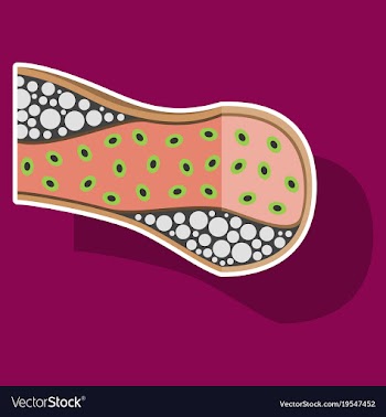 Sticker vienna human atherosclerosisthe structure vector image