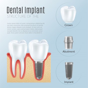 Structure of dental prosthetics infographics Free Vector