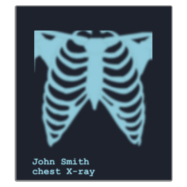 SVG Chest X-ray image