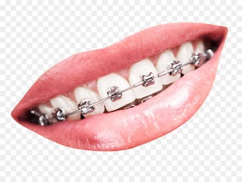 Tooth Dental braces Dentistry - Teeth With Braces 