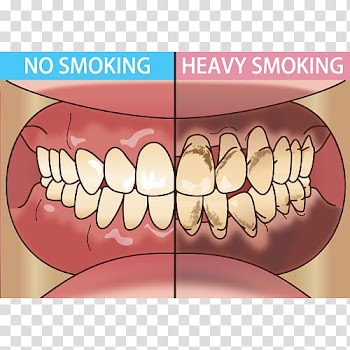 Tooth Dentist Periodontal disease Tobacco smoking 歯科, tongue transparent background PNG clipart