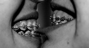 Two people touch their mouths with their tongues, they have braces