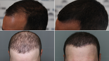 What Is Scalp Micropigmentation? SMP Explained | Hairline Ink