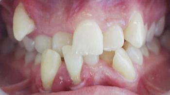 What really makes your teeth crooked? | Aaj News