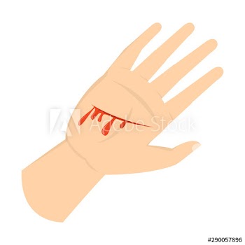 Wound on the hand palm